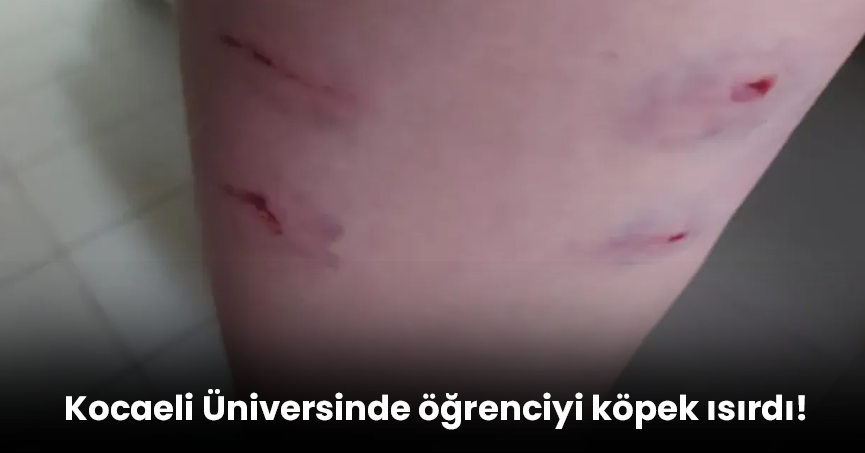 Kocaeli Üniversinde öğrenciyi köpek ısırdı!